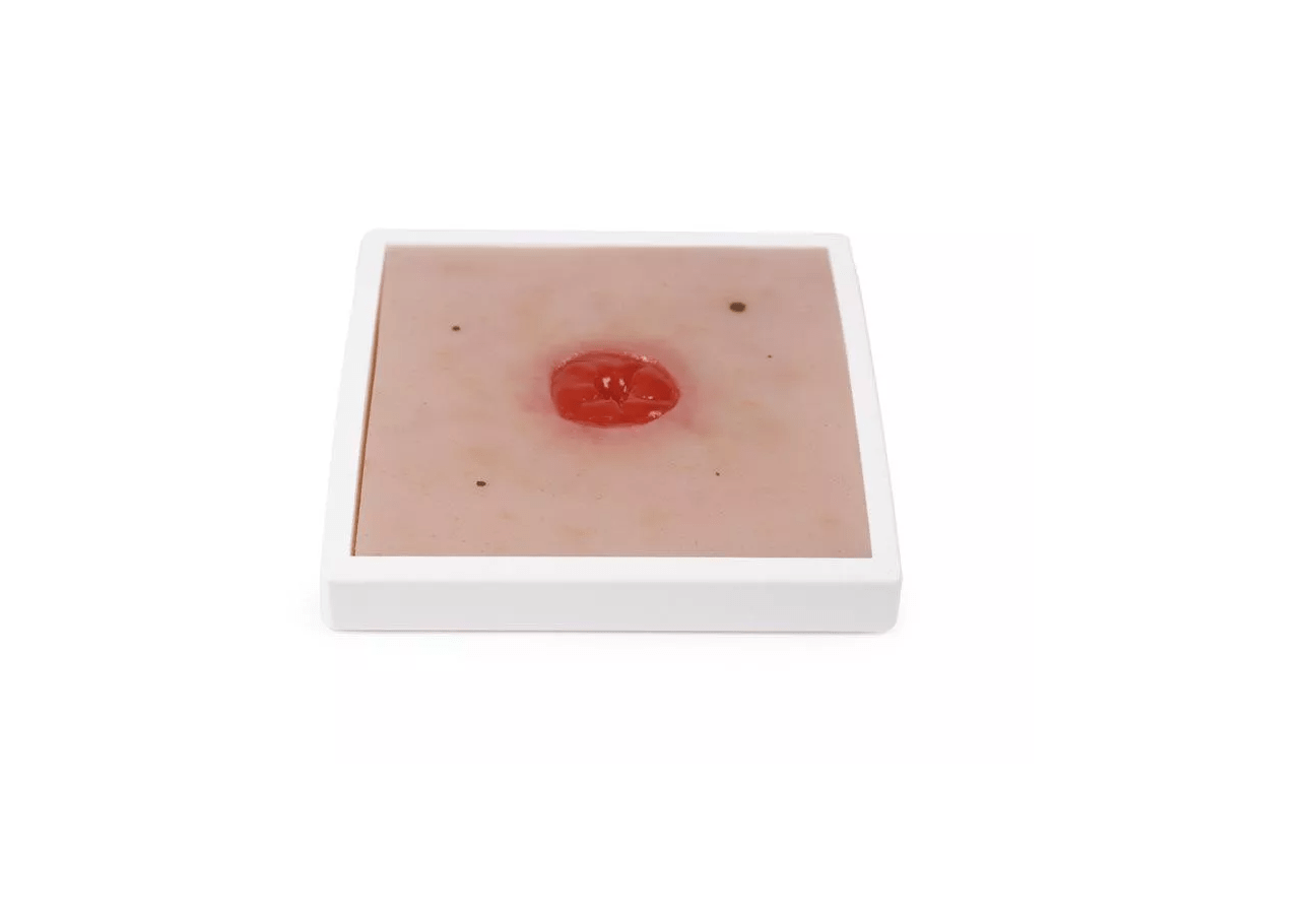 Wundmoulage Kolostoma unter Hautniveau - Erler - Zimmer